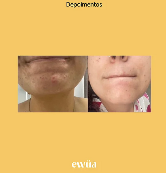 Kit Peles Mistas e Oleosas